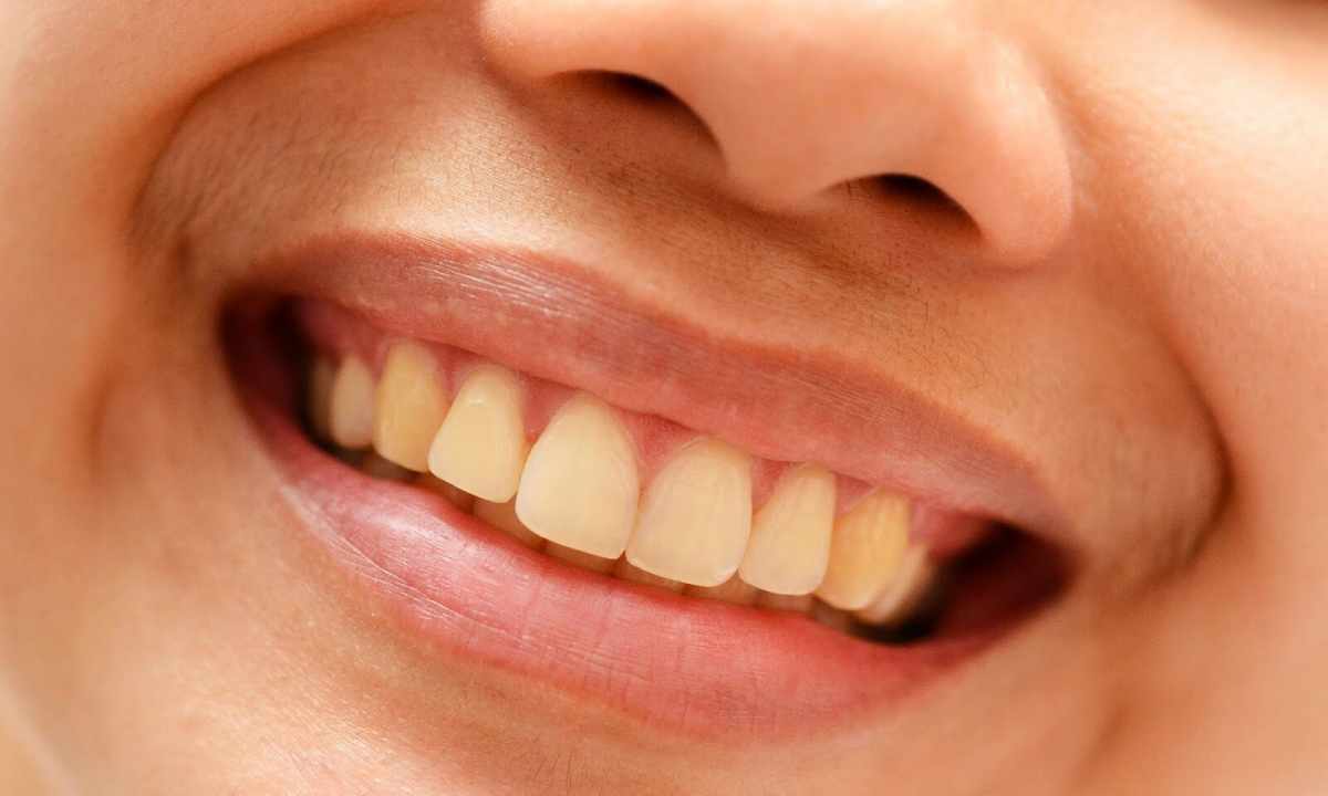 How to remove yellowness on teeth